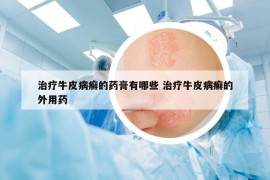 治療牛皮病癬的藥膏有哪些 治療牛皮病癬的外用藥