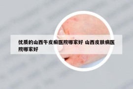 優(yōu)質(zhì)的山西牛皮癬醫(yī)院哪家好 山西皮膚病醫(yī)院哪家好