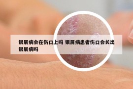 銀屑病會在傷口上嗎 銀屑病患者傷口會長出銀屑病嗎