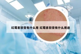 紅霉素軟膏有什么用 紅霉素軟膏有什么用途