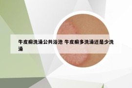 牛皮癬洗澡公共浴池 牛皮癬多洗澡還是少洗澡