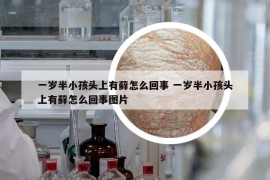 一歲半小孩頭上有蘚怎么回事 一歲半小孩頭上有蘚怎么回事圖片