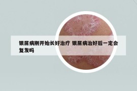 銀屑病剛開始長好治療 銀屑病治好后一定會復(fù)發(fā)嗎