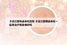 卡泊三醇和鹵米松混用 卡泊三醇跟鹵米松一起用治療銀屑病好嗎