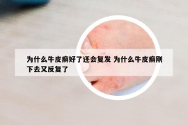 為什么牛皮癬好了還會(huì)復(fù)發(fā) 為什么牛皮癬剛下去又反復(fù)了