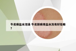 牛皮癬鹽水泡澡 牛皮膚癬用鹽水洗有好處嘛?