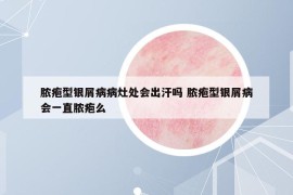 膿皰型銀屑病病灶處會(huì)出汗嗎 膿皰型銀屑病會(huì)一直膿皰么