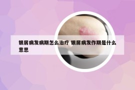 銀屑病發(fā)病期怎么治療 銀屑病發(fā)作期是什么意思