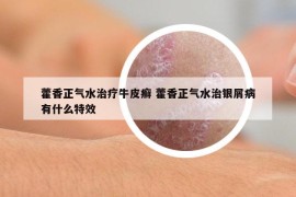 藿香正氣水治療牛皮癬 藿香正氣水治銀屑病有什么特效