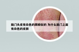 腦門頭皮有白色的跟癬似的 為什么腦門上面有白色的皮膚