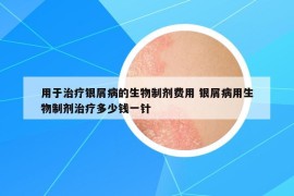 用于治療銀屑病的生物制劑費(fèi)用 銀屑病用生物制劑治療多少錢一針