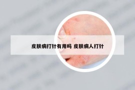 皮膚病打針有用嗎 皮膚病人打針