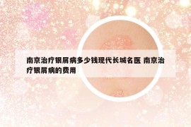 南京治療銀屑病多少錢現(xiàn)代長城名醫(yī) 南京治療銀屑病的費(fèi)用