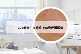 308能治牛皮癬嗎 308光療銀屑病
