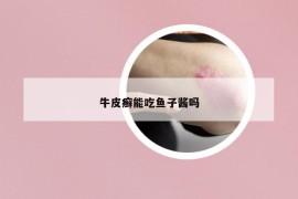 牛皮癬能吃魚(yú)子醬嗎