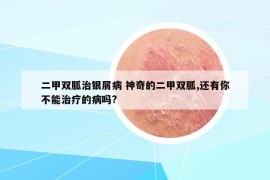 二甲雙胍治銀屑病 神奇的二甲雙胍,還有你不能治療的病嗎?