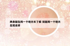 兩條腿在同一個(gè)地方長了癬 雙腿同一個(gè)地方出現(xiàn)皮疹