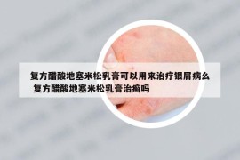 復(fù)方醋酸地塞米松乳膏可以用來(lái)治療銀屑病么 復(fù)方醋酸地塞米松乳膏治癬嗎
