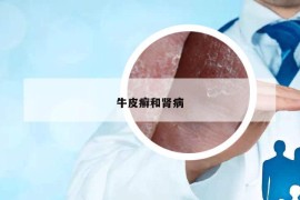 牛皮癬和腎病