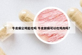 牛皮癬公雞能吃嗎 牛皮膚癬可以吃雞肉嗎?