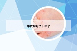 牛皮癬好了十年了