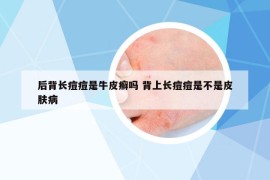 后背長痘痘是牛皮癬嗎 背上長痘痘是不是皮膚病