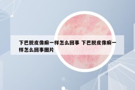 下巴脫皮像癬一樣怎么回事 下巴脫皮像癬一樣怎么回事圖片