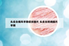 頭皮白癜風(fēng)早期癥狀圖片 頭皮白斑病圖片 早期