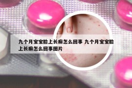 九個月寶寶臉上長癬怎么回事 九個月寶寶臉上長癬怎么回事圖片