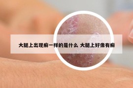 大腿上出現(xiàn)癬一樣的是什么 大腿上好像有癬