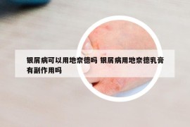 銀屑病可以用地奈德嗎 銀屑病用地奈德乳膏有副作用嗎