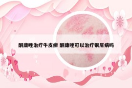 酮康唑治療牛皮癬 酮康唑可以治療銀屑病嗎