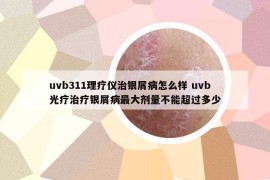 uvb311理療儀治銀屑病怎么樣 uvb光療治療銀屑病最大劑量不能超過多少