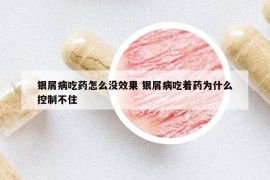 銀屑病吃藥怎么沒效果 銀屑病吃著藥為什么控制不住