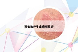 西安治療牛皮癬哪里好