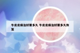 牛皮皮癬治好要多久 牛皮皮癬治好要多久恢復(fù)