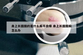 身上長圓圈的是什么癬不會癢 身上長圓圈癬怎么辦