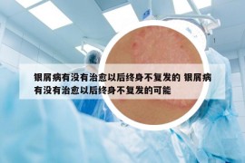 銀屑病有沒(méi)有治愈以后終身不復(fù)發(fā)的 銀屑病有沒(méi)有治愈以后終身不復(fù)發(fā)的可能