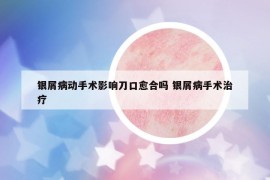 銀屑病動手術(shù)影響刀口愈合嗎 銀屑病手術(shù)治療