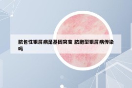 膿包性銀屑病是基因突變 膿胞型銀屑病傳染嗎