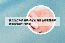 商丘治療牛皮癬的好方法 商丘治療銀屑病鄭州銀屑病研究院地址