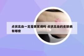 點狀出血一定是銀屑病嗎 點狀出血的皮膚病有哪些