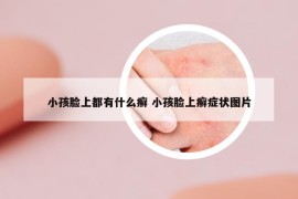 小孩臉上都有什么癬 小孩臉上癬癥狀圖片