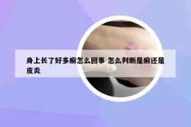 身上長了好多癬怎么回事 怎么判斷是癬還是皮炎