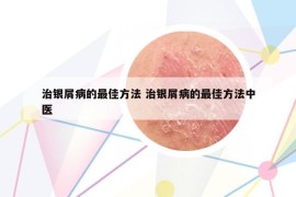治銀屑病的最佳方法 治銀屑病的最佳方法中醫(yī)