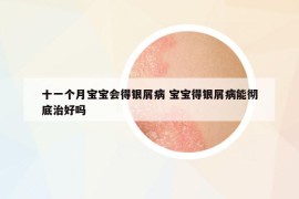十一個(gè)月寶寶會(huì)得銀屑病 寶寶得銀屑病能徹底治好嗎