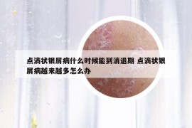 點滴狀銀屑病什么時候能到消退期 點滴狀銀屑病越來越多怎么辦
