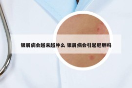 銀屑病會(huì)越來越腫么 銀屑病會(huì)引起肥胖嗎