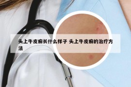 頭上牛皮癬長什么樣子 頭上牛皮癬的治療方法
