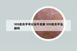 999皮炎平可以治牛皮癬 999皮炎平治蘚嗎